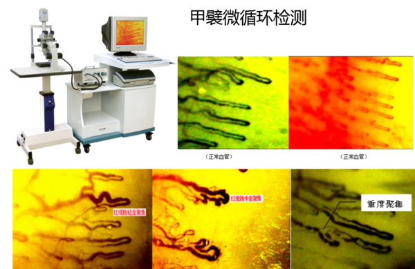 甲襞微循环分析—通过观察手指甲微毛细血管形态,分析体内血液循环